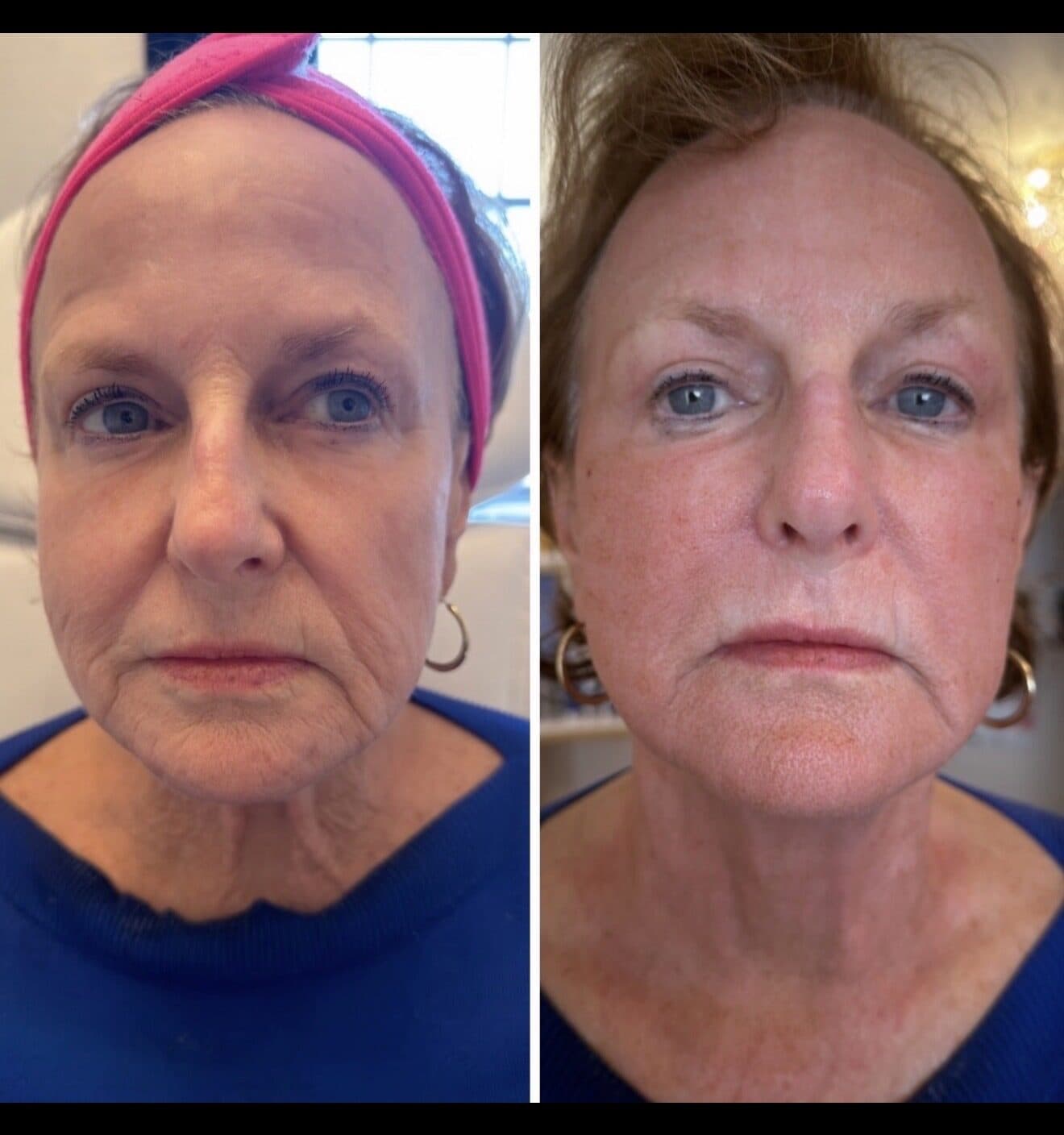 HELIX DEKA FUSION + CO2 Resurfacing