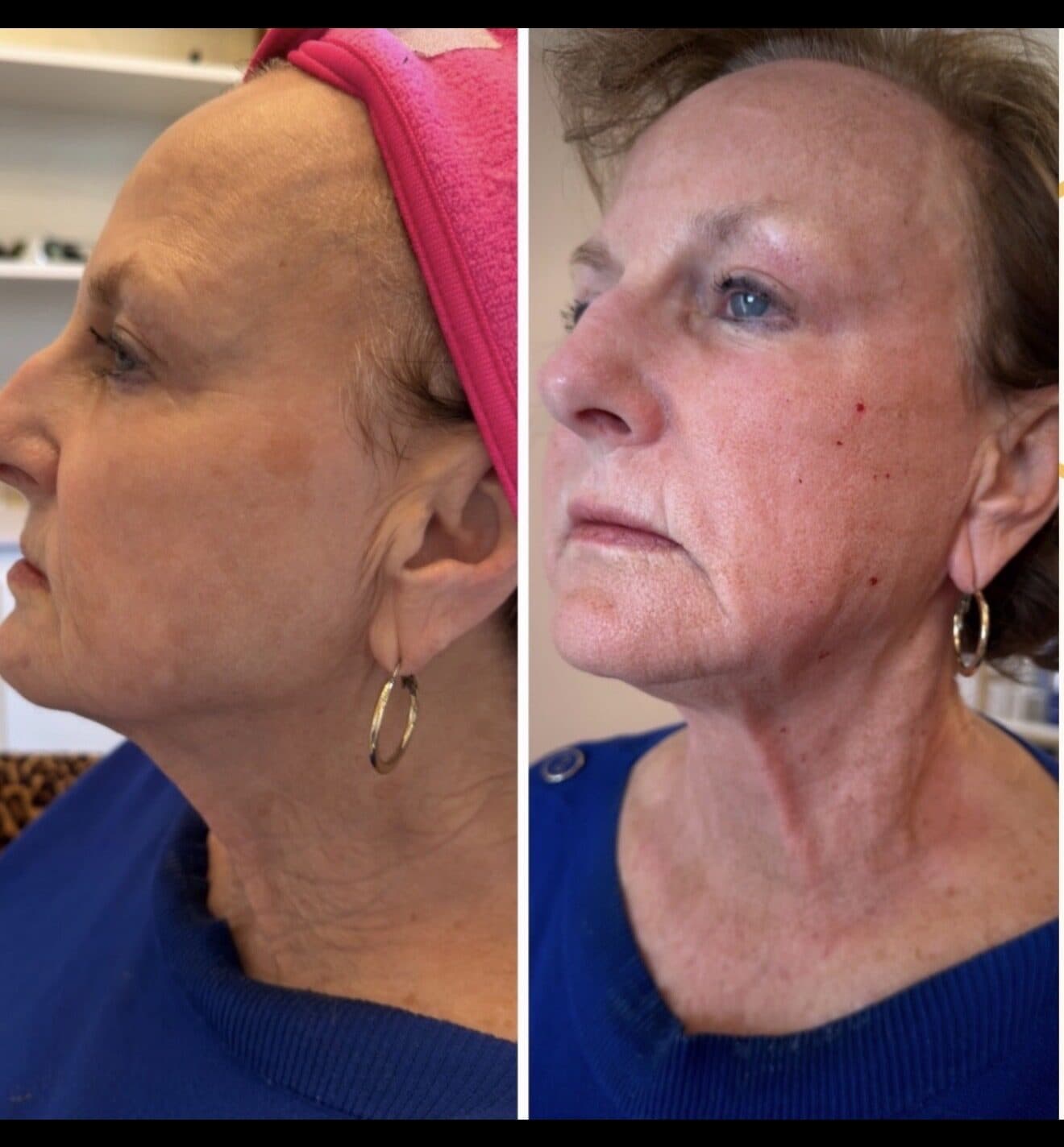 HELIX DEKA FUSION + CO2 Resurfacing