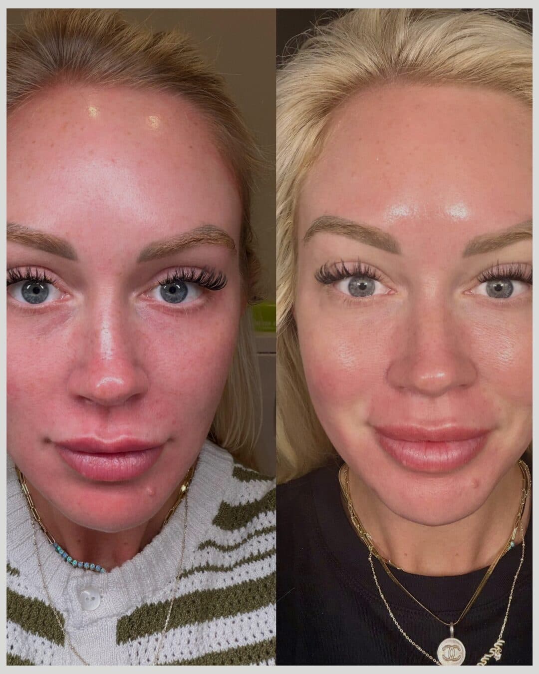 Microneedling + Accelerated Brightening Serum