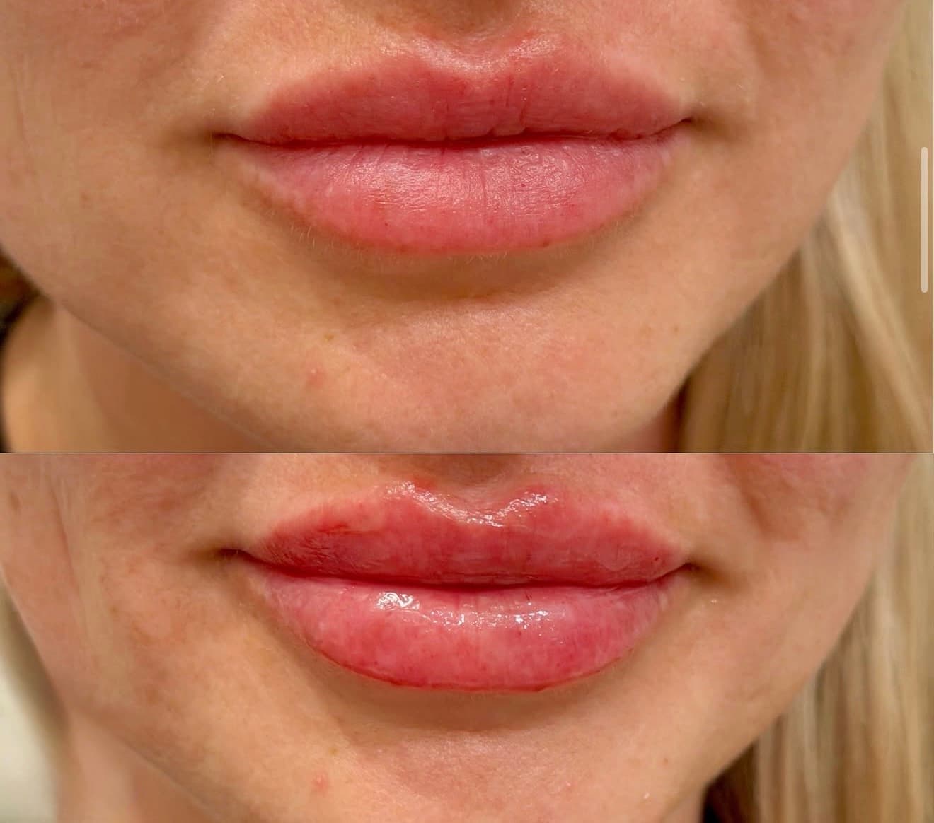 Lip Filler