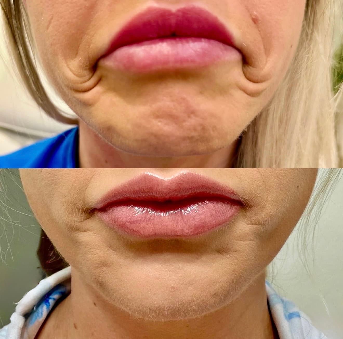 Lower Face Tox