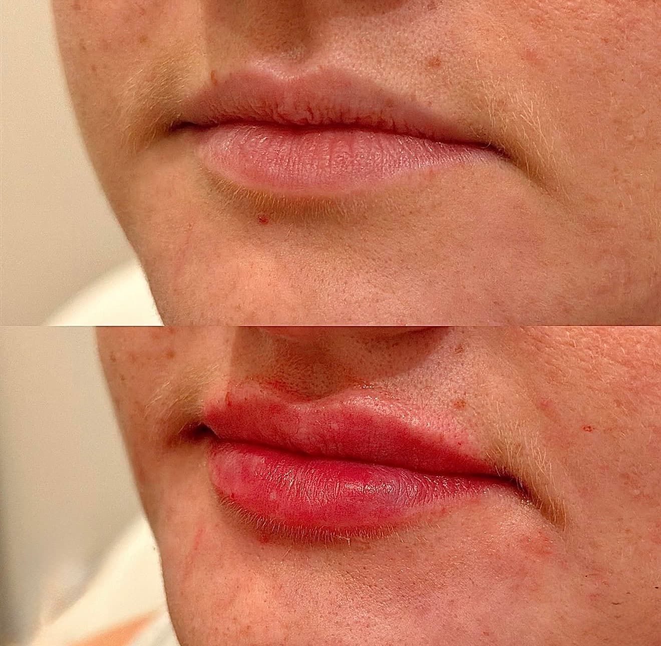 Lip Filler